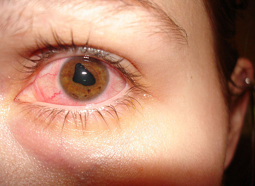 Inflammation de l'iris