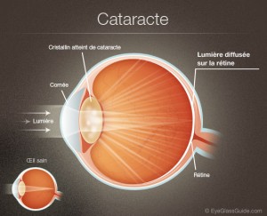 La cataracte