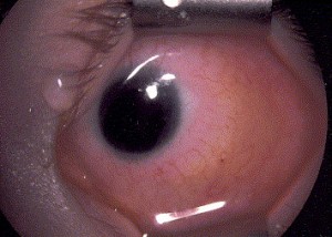 Sémiologie de la pupille