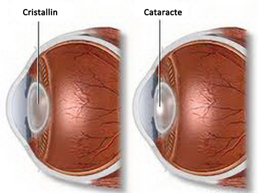 Cristallin cataracté