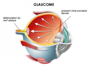Le glaucome