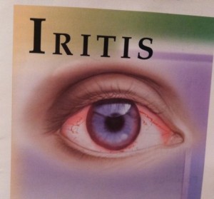 Iritis