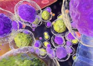 Leucémie lymphoïde