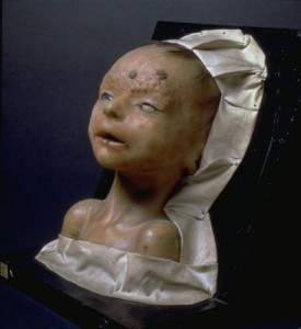 Syphilis congénitale
