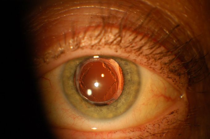 Cataracte secondaire