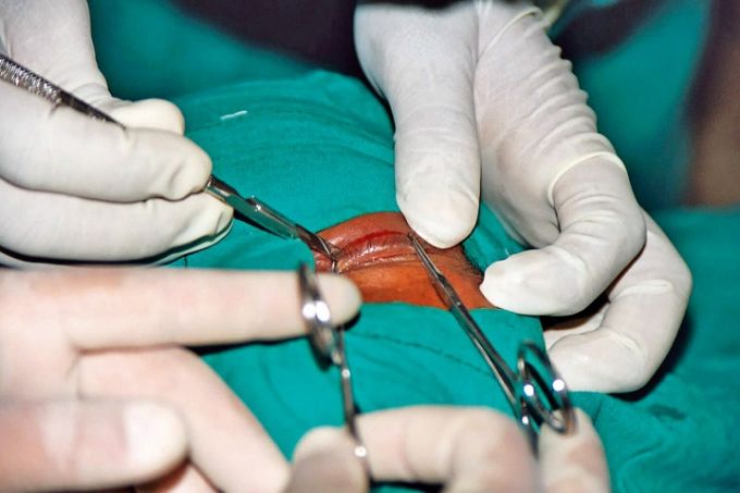 Chirurgie du trichiasis