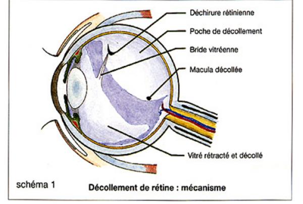 Le décollement de la rétine