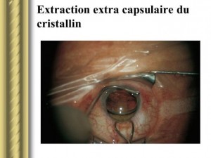 Extraction extra-capsulaire