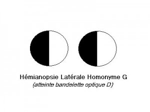 Hémianopsie latérale homonyme