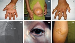 Hypercholesterinémie