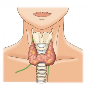 Insuffisance parathyroïdienne