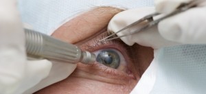 Opération de cataracte