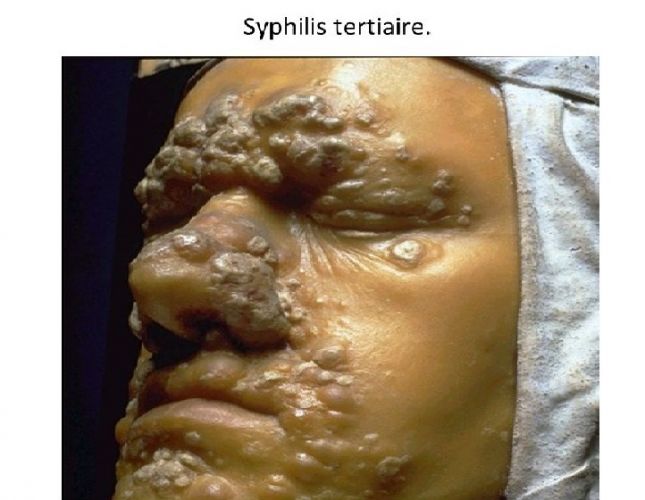 Syphilis tertiaire