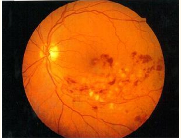 Thrombose de la veine oculaire