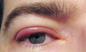 œdème rouge des paupières