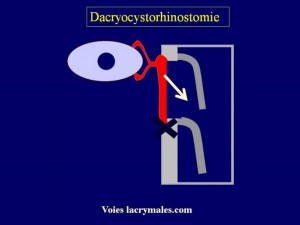 La dacryocysto-rhinostomie