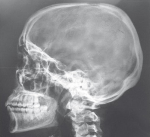 La radiographie du crâne