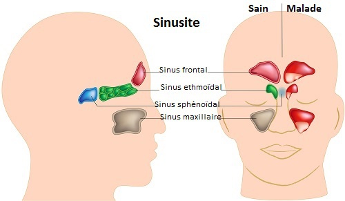 Le sinus maxillaire