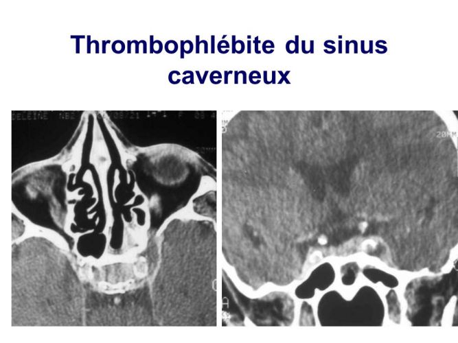 La thrombo-phlébite du sinus caverneux