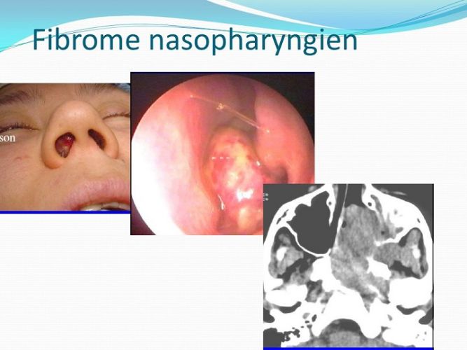 Fibrome-naso-pharyngien