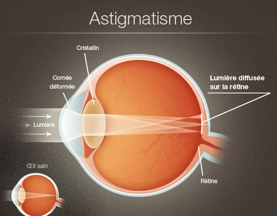 L'astigmatisme