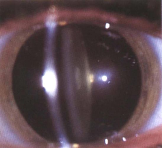 Le cataracte zonulaire