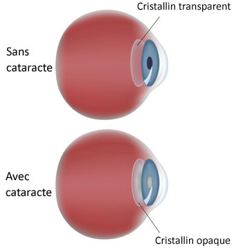 Cristallin cataracté
