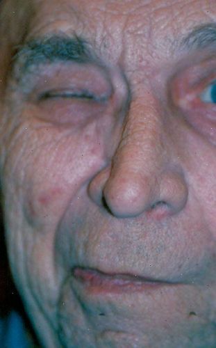L'hémispasme facial