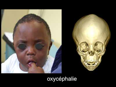 Oxycéphalie