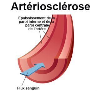 Artério-sclérose