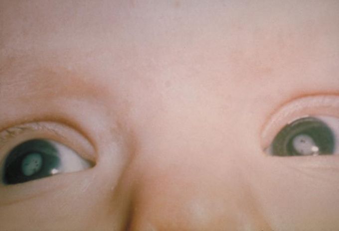 Le cataracte infantile