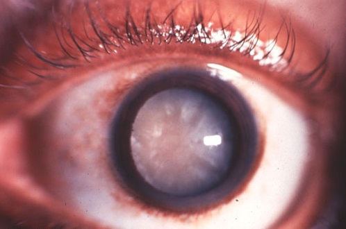 Cataracte sénile