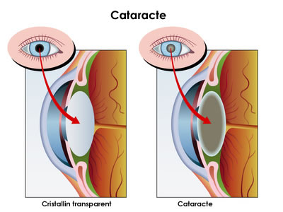 Le cristallin cataracté