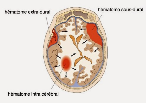 Hématome extra et sous dural