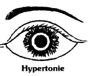 L'hypertonie oculaire